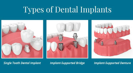 Dental Implants or Dentures: A Simple Guide for Seniors